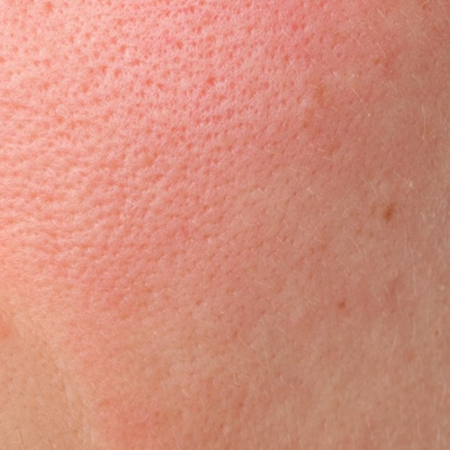 რა არის რეაქტიული კანი?