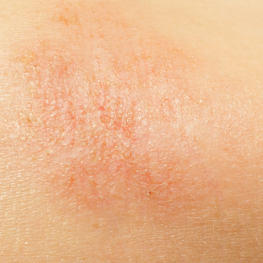 რა არის ატოპიური დერმატიტი?