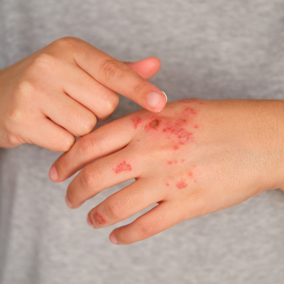 DA PROTECT - ტოპიკრემის ქავილისა და გაღიზიანების საწინააღდეგო ხაზი