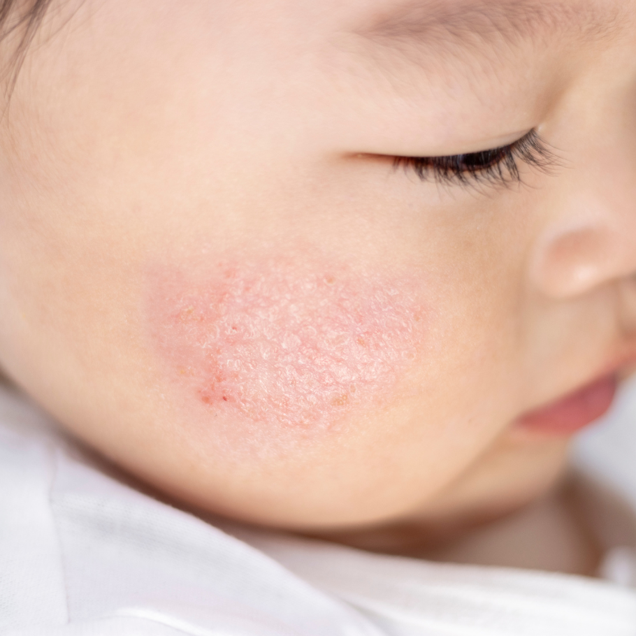 TOPICREM DA PROTECT სახის კრემი -  სპეციალურად შექმნილია ატოპიური კანის მოსავლელად.