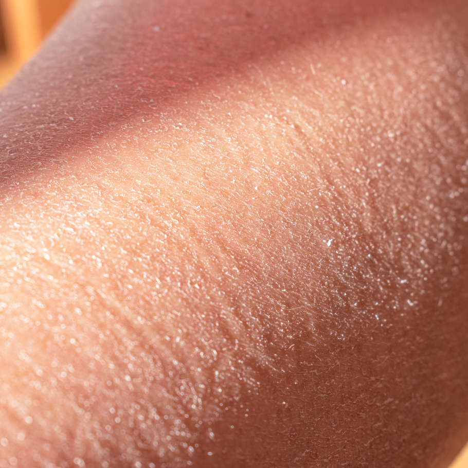 რა არის კანის გამოშრობა?