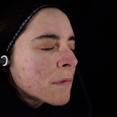 ტოპიკრემი - ინტენსიური სახის შრატი ცხიმიანი და კომბინირებული კანისათვის შემდგომ*