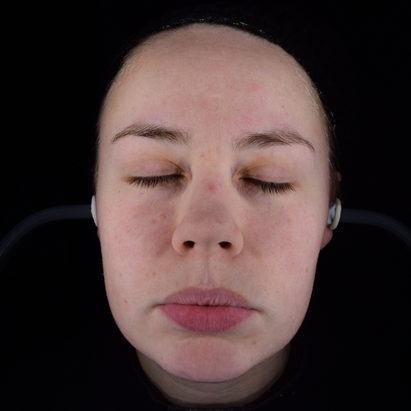 ტოპიკრემი - გამონაყარის საწინააღმდეგო კრემი ცხიმიანი და კომბინირებული კანისათვის შემდგომ*