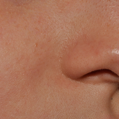 ტოპიკრემი - კანის დამაშვიდებელი სახის კრემი ძალიან მშრალი და ატოპიური კანისათვის შემდგომ*