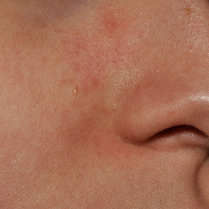 ტოპიკრემი - კანის დამაშვიდებელი სახის კრემი ძალიან მშრალი და ატოპიური კანისათვის გამოყენებამდე*