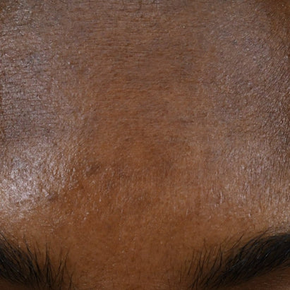 ტოპიკრემი - პიგმენტური ლაქების საწინააღმდეგო სახის შრატი შემდგომ*