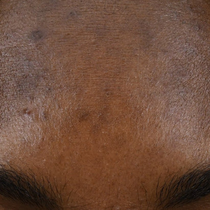 ტოპიკრემი - პიგმენტური ლაქების საწინააღმდეგო სახის შრატი გამოყენებამდე*